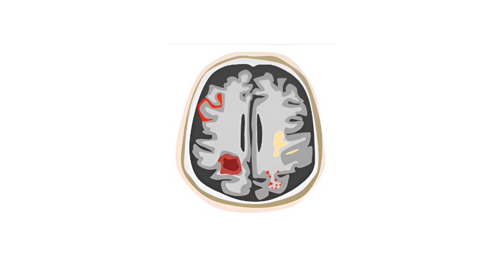 FDA authorizes the first AI-driven MRI solution for safer Alzheimer’s treatment